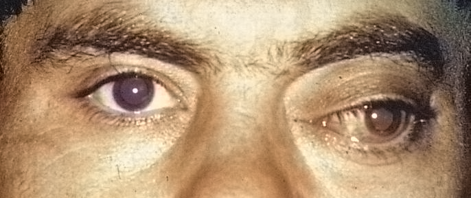 экзофтальм глаза у мужчины